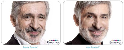 Emervel: antes y después