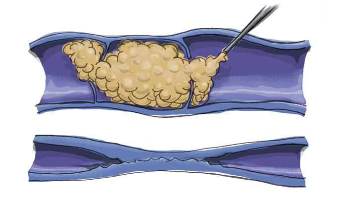 Fleboesclerosis Con Microespuma El Polidocanol Venas Varices Polidocanol Varicoso Paseo Mitre Dodecanol Escleroterapia Con Microespuma Escleroterapia Microespuma Daniel Pacheco Esteticamedica Info Medicina Estetica En Internet