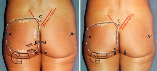 lifting gluteos