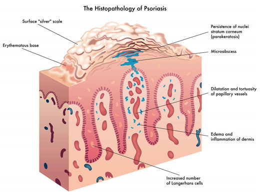 psoriasis