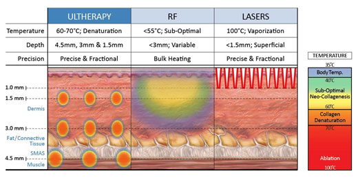 Ultherapy