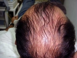 Tratamiento de la alopecia con Plasma Rico en Plaquetas