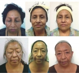 Melasma: tratamiento mesoterpico con cido tranexmico al 5%