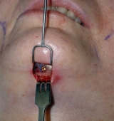 Esttica del mentn: una ciruga sencilla y con buenos resultados