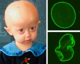 Progeria: sorprendente hallazgo científico podría ser clave para frenar el paso del tiempo