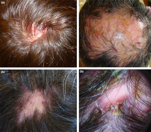 Un tipo raro de alopecia cicatricial: foliculitis decalvante
