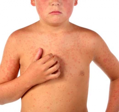 La psoriasis la derrota de las articulaciones el tratamiento