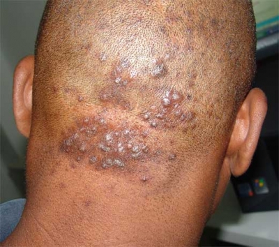 La cutis negro los puntos