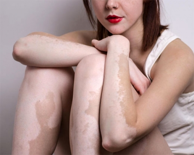 Vitiligo: causas, tipos, evolución y tratamientos
