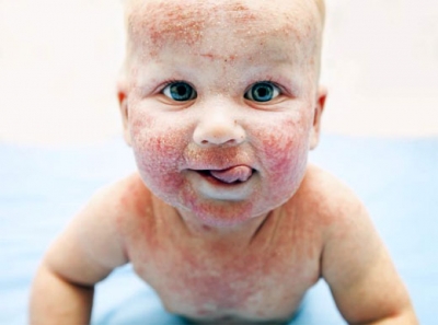 Dermatitis atópica: causas, efectos y estrategias para limitar su evolución